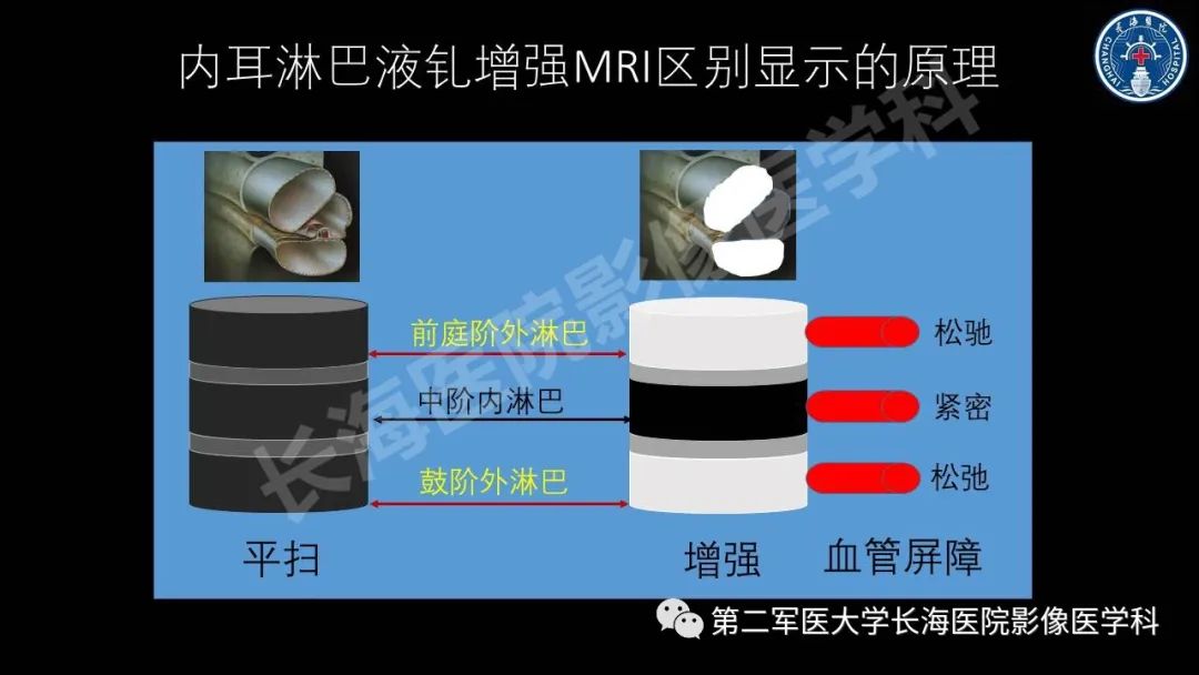 影像PPT - 【PPT】钆增强MRI检测梅尼埃病内淋巴积水的技术与临床应用-8