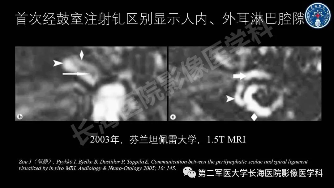 影像PPT - 【PPT】钆增强MRI检测梅尼埃病内淋巴积水的技术与临床应用-12