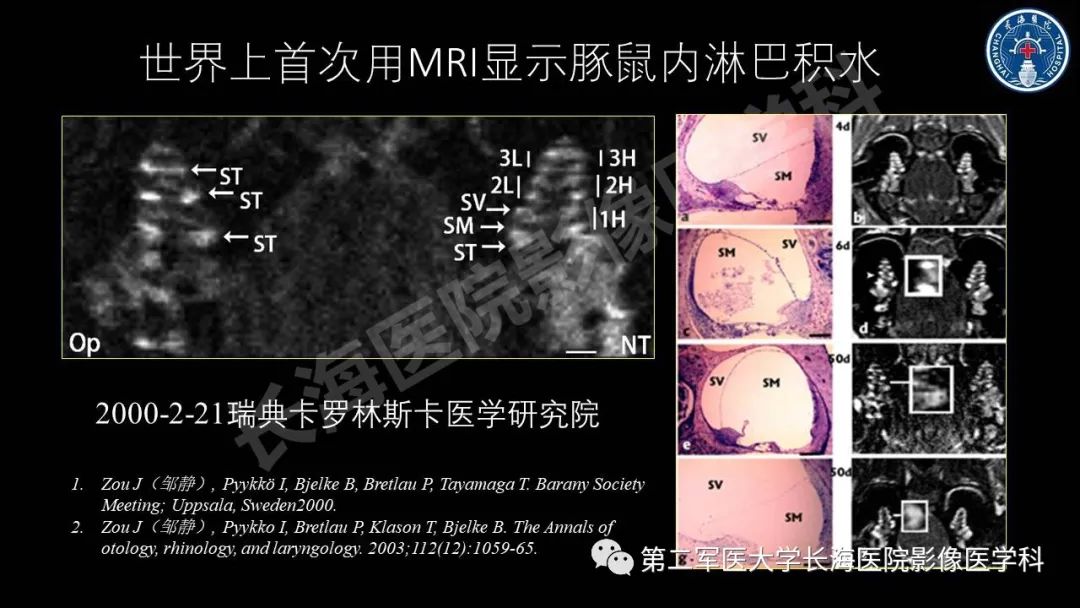 影像PPT - 【PPT】钆增强MRI检测梅尼埃病内淋巴积水的技术与临床应用-10