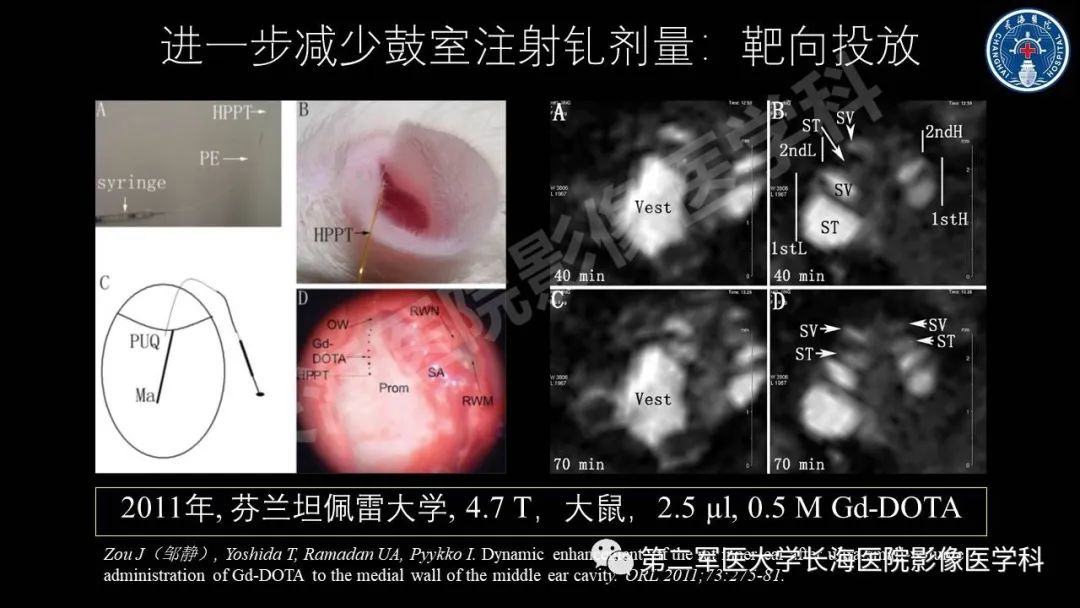 影像PPT - 【PPT】钆增强MRI检测梅尼埃病内淋巴积水的技术与临床应用-13