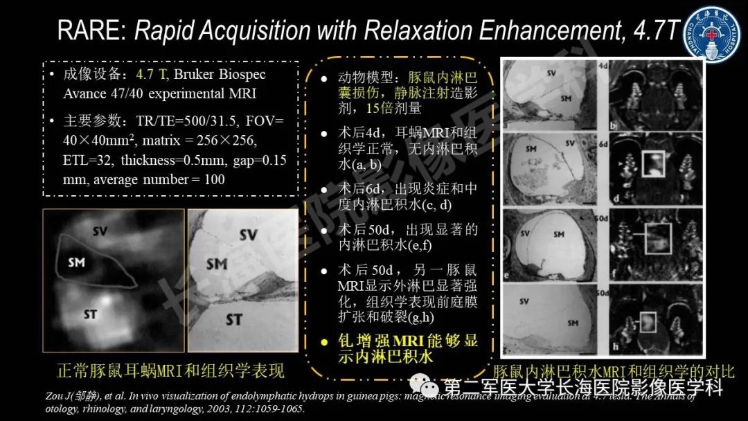 影像PPT - 【PPT】钆增强MRI检测梅尼埃病内淋巴积水的技术与临床应用-16