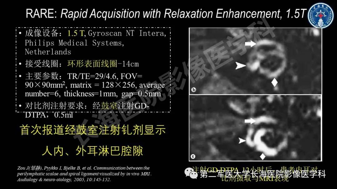 影像PPT - 【PPT】钆增强MRI检测梅尼埃病内淋巴积水的技术与临床应用-17