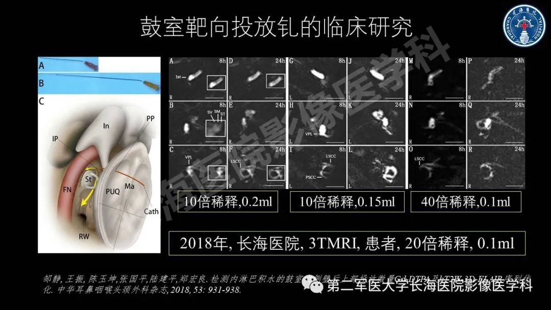 影像PPT - 【PPT】钆增强MRI检测梅尼埃病内淋巴积水的技术与临床应用-14