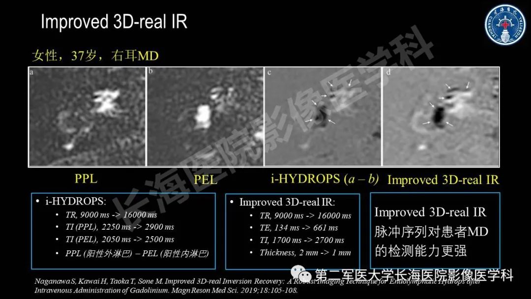 影像PPT - 【PPT】钆增强MRI检测梅尼埃病内淋巴积水的技术与临床应用-24