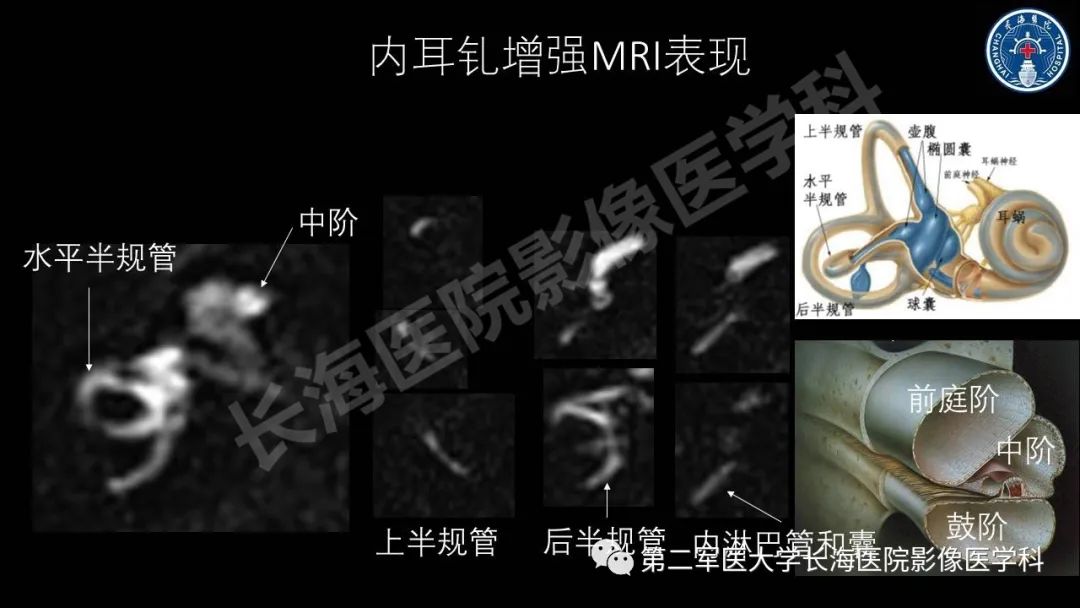 影像PPT - 【PPT】钆增强MRI检测梅尼埃病内淋巴积水的技术与临床应用-27