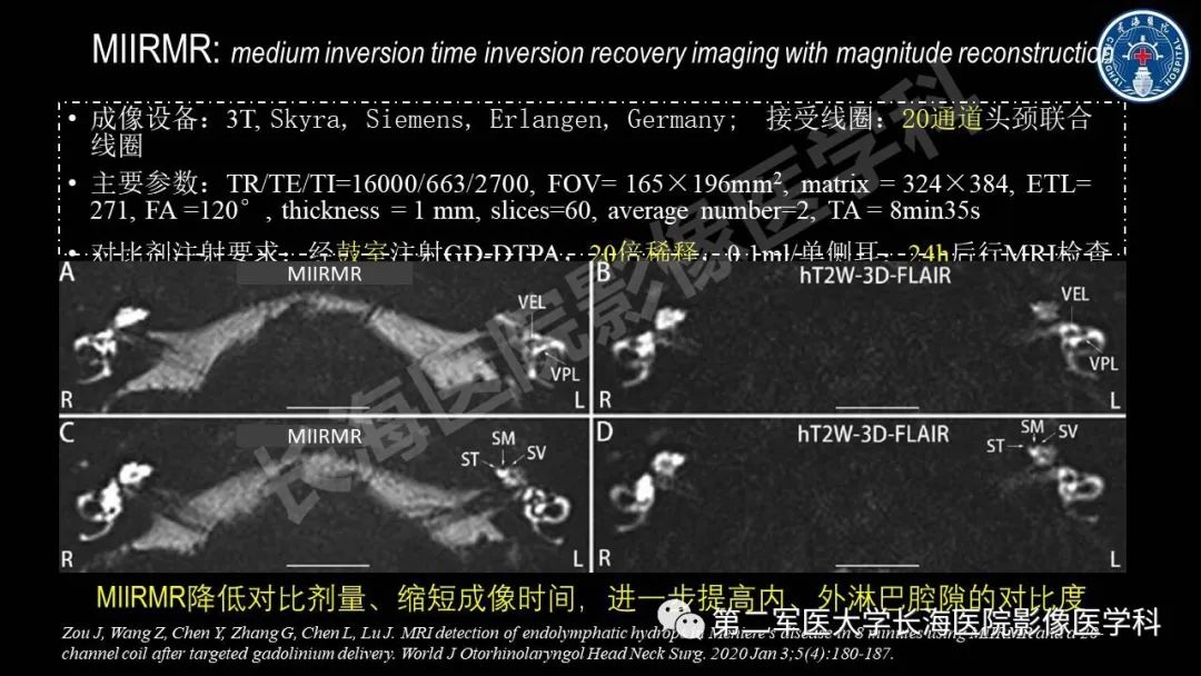 影像PPT - 【PPT】钆增强MRI检测梅尼埃病内淋巴积水的技术与临床应用-25