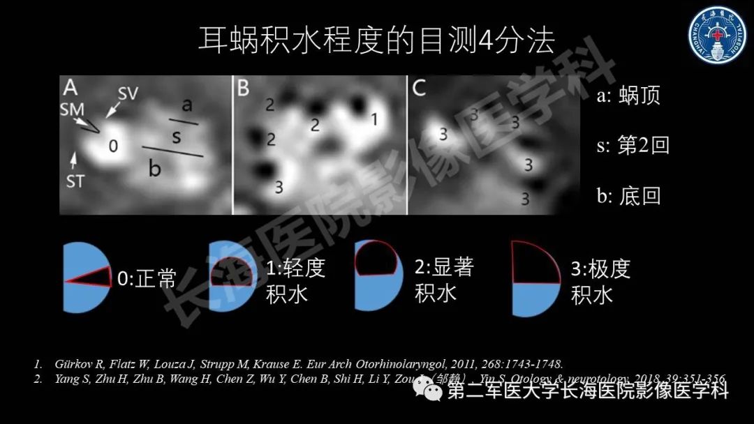 影像PPT - 【PPT】钆增强MRI检测梅尼埃病内淋巴积水的技术与临床应用-29