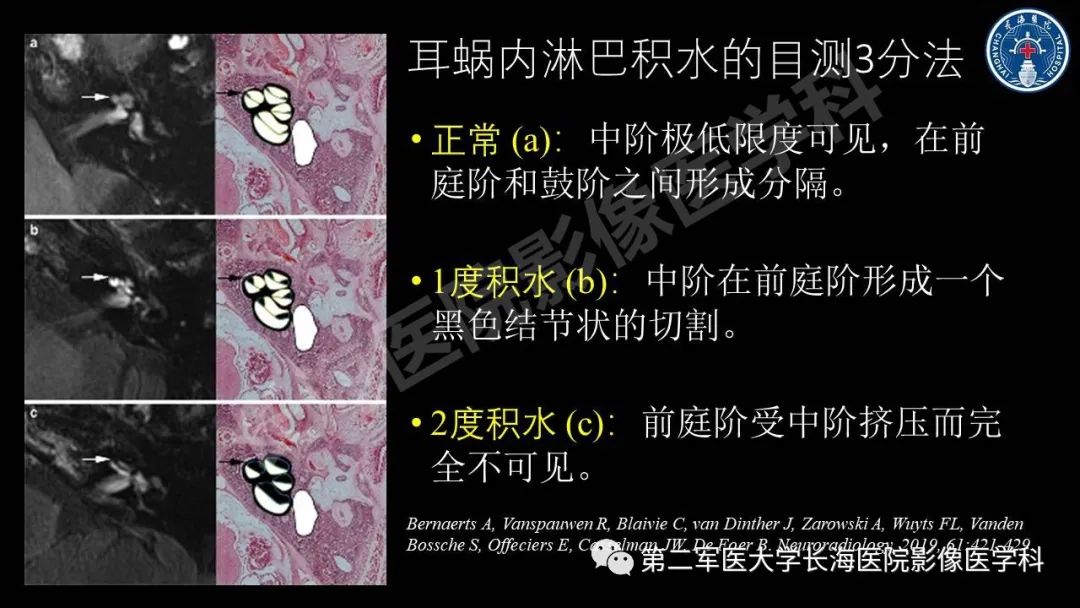 影像PPT - 【PPT】钆增强MRI检测梅尼埃病内淋巴积水的技术与临床应用-30