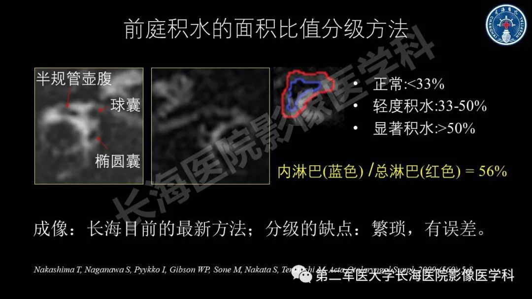 影像PPT - 【PPT】钆增强MRI检测梅尼埃病内淋巴积水的技术与临床应用-32