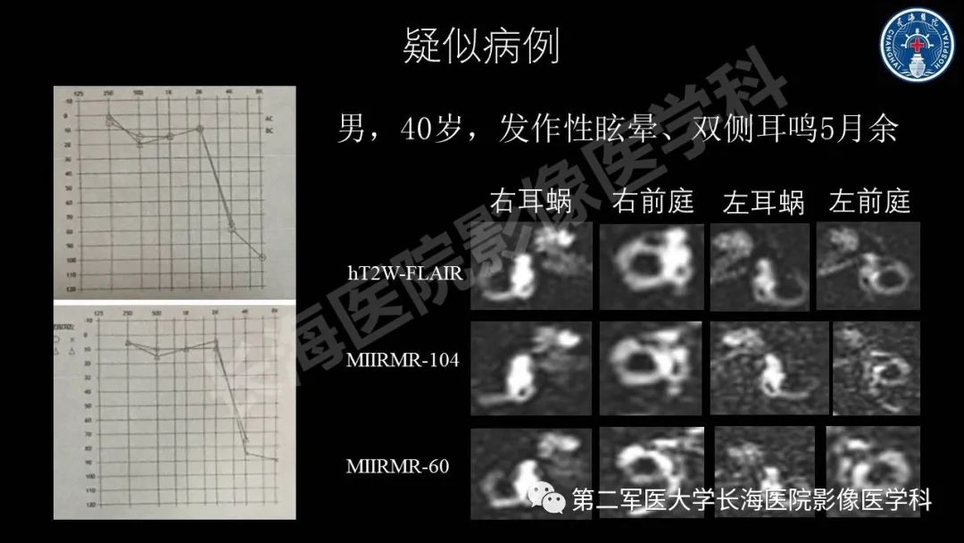 影像PPT - 【PPT】钆增强MRI检测梅尼埃病内淋巴积水的技术与临床应用-36