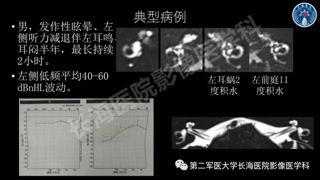 影像PPT - 【PPT】钆增强MRI检测梅尼埃病内淋巴积水的技术与临床应用-34