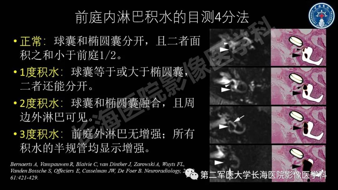 影像PPT - 【PPT】钆增强MRI检测梅尼埃病内淋巴积水的技术与临床应用-33