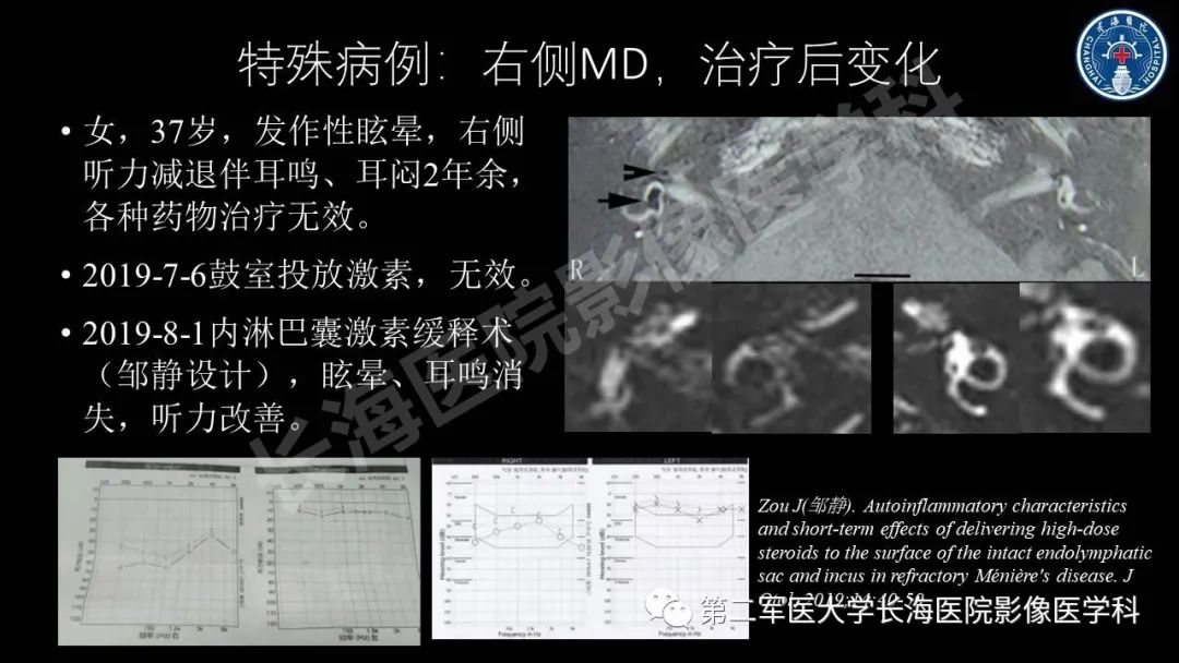 影像PPT - 【PPT】钆增强MRI检测梅尼埃病内淋巴积水的技术与临床应用-35