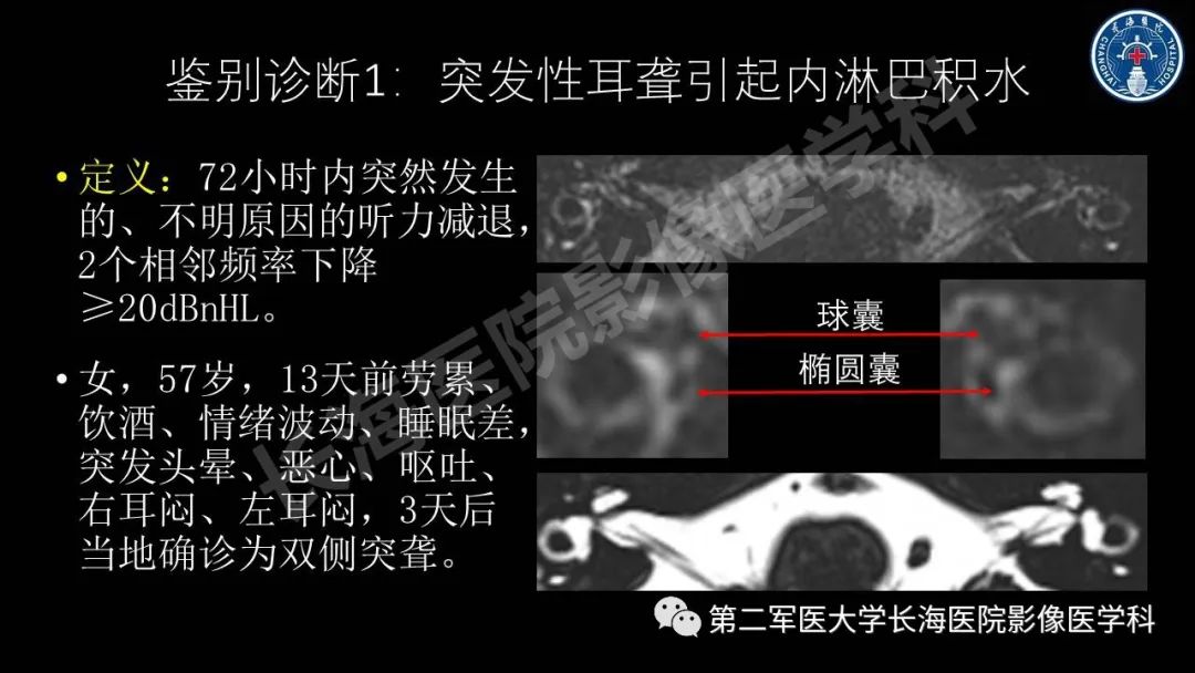 影像PPT - 【PPT】钆增强MRI检测梅尼埃病内淋巴积水的技术与临床应用-37