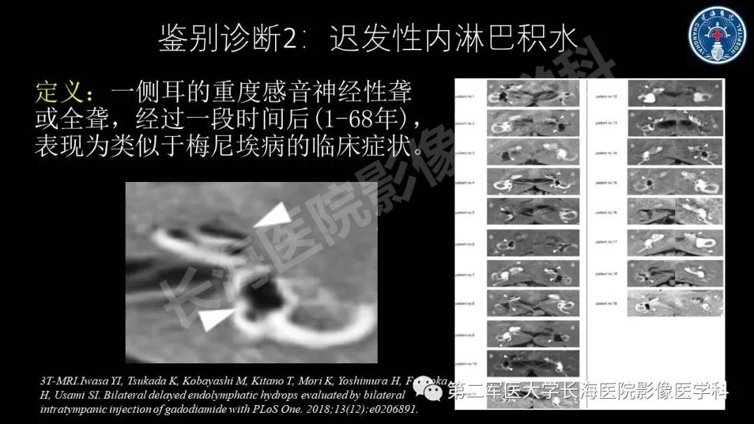 影像PPT - 【PPT】钆增强MRI检测梅尼埃病内淋巴积水的技术与临床应用-38
