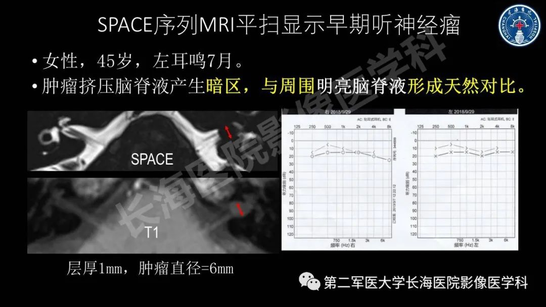 影像PPT - 【PPT】钆增强MRI检测梅尼埃病内淋巴积水的技术与临床应用-40