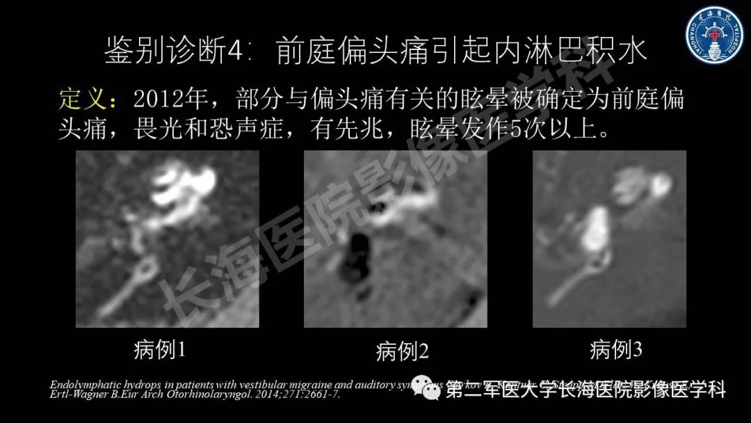 影像PPT - 【PPT】钆增强MRI检测梅尼埃病内淋巴积水的技术与临床应用-41