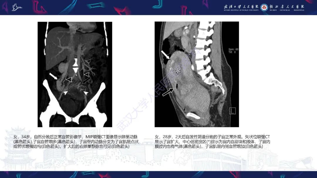 影像PPT - 【PPT】产后并发症影像诊断-5