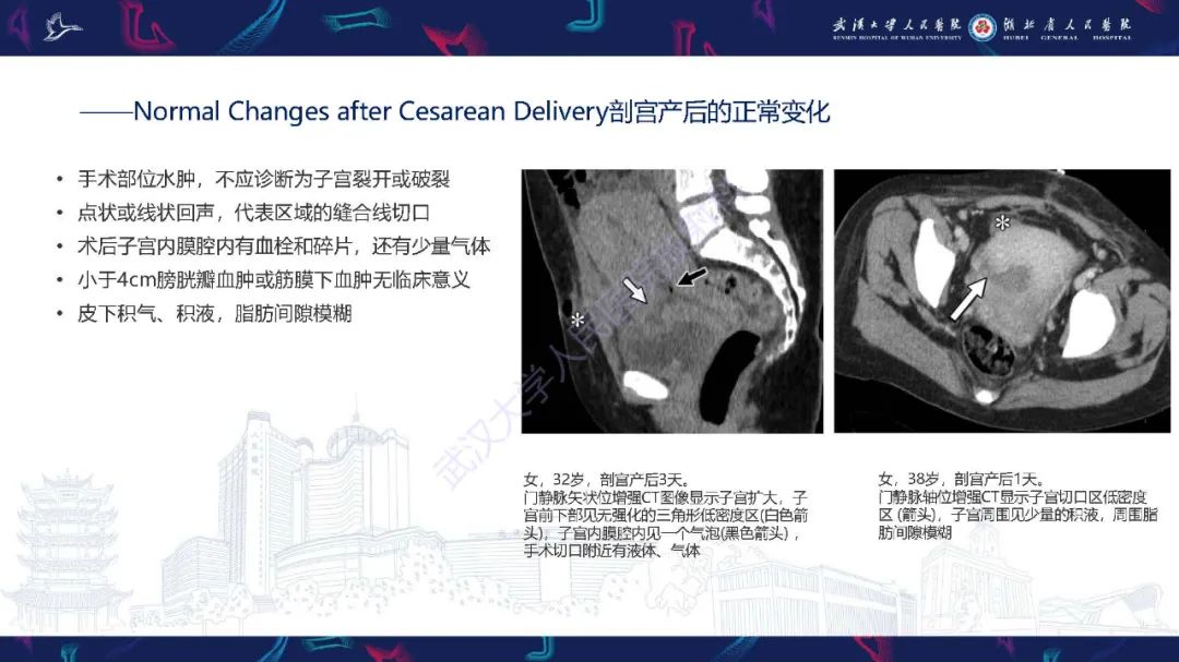 影像PPT - 【PPT】产后并发症影像诊断-6