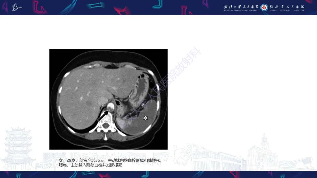 影像PPT - 【PPT】产后并发症影像诊断-10