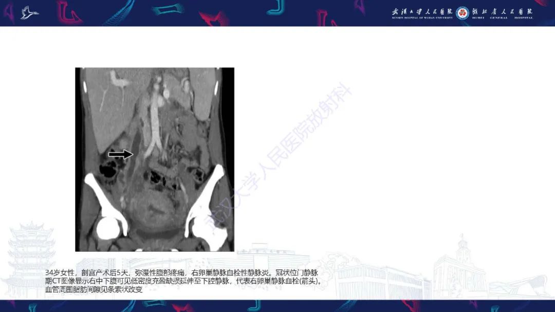 影像PPT - 【PPT】产后并发症影像诊断-13
