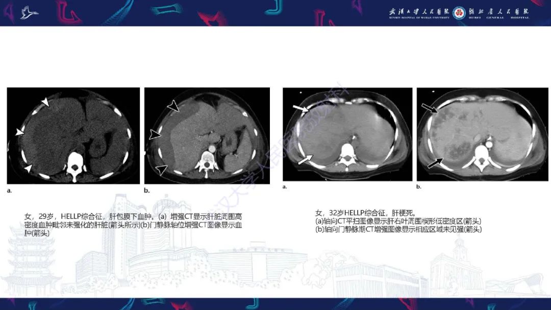影像PPT - 【PPT】产后并发症影像诊断-15