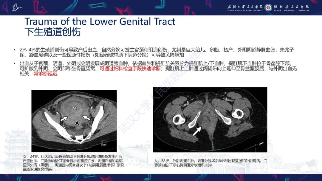 影像PPT - 【PPT】产后并发症影像诊断-20