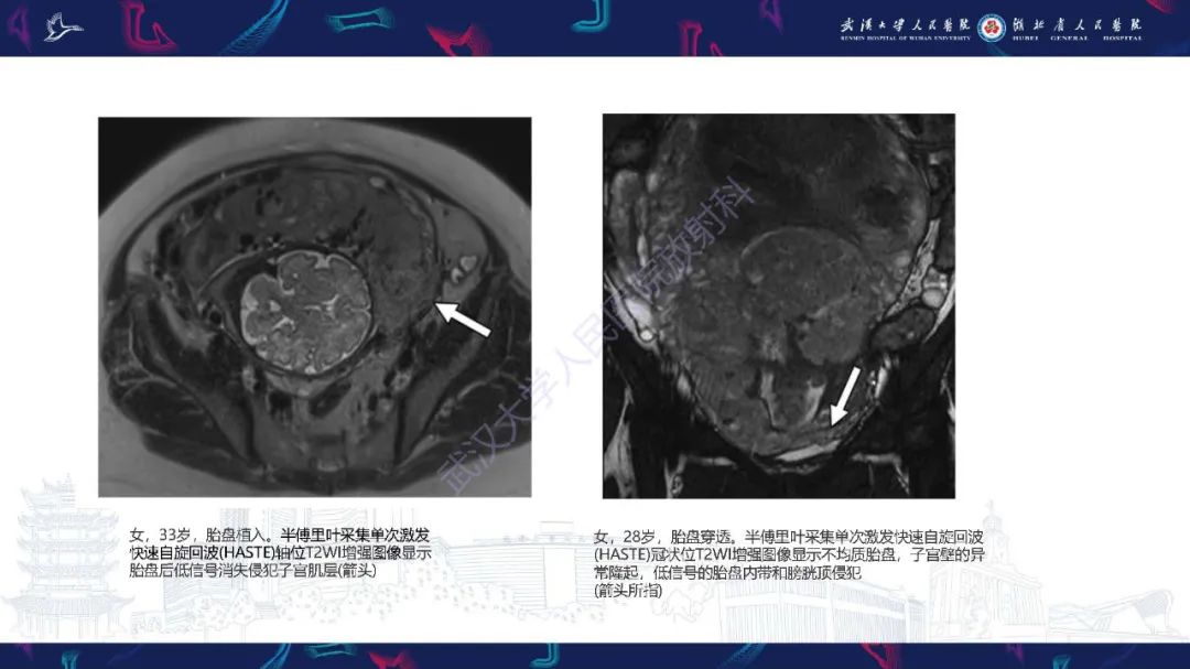 影像PPT - 【PPT】产后并发症影像诊断-22
