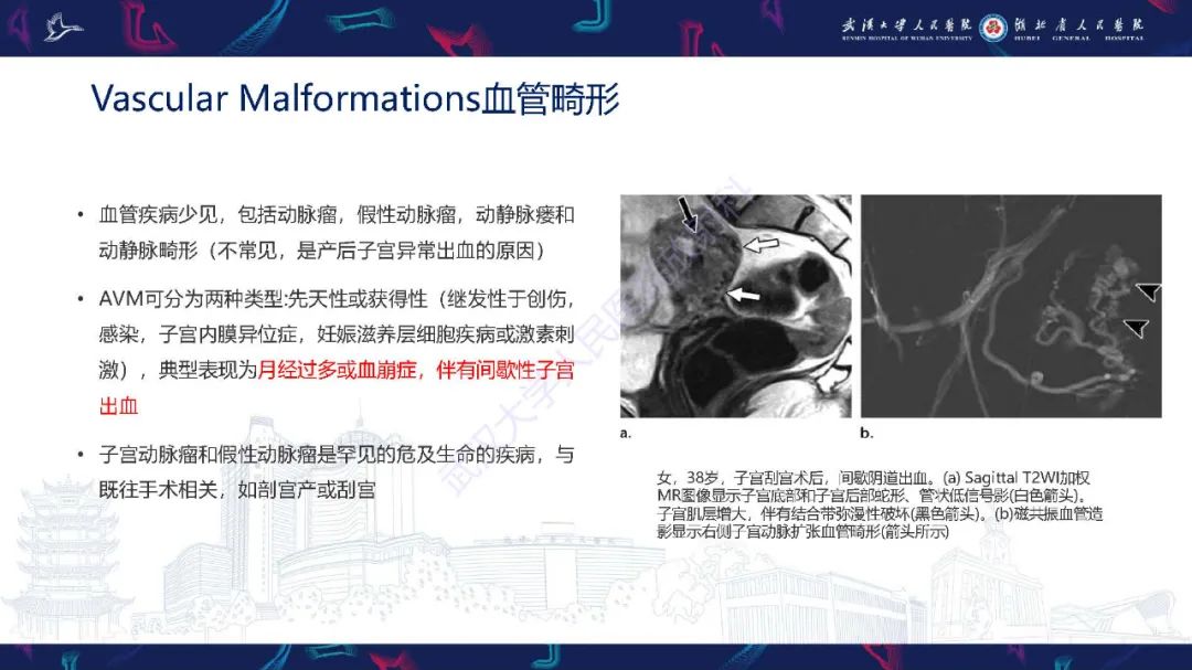 PPT】产后并发症影像诊断u2013 影像PPT