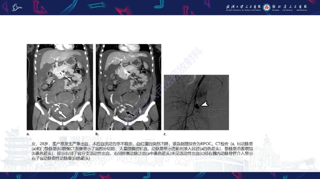 影像PPT - 【PPT】产后并发症影像诊断-27