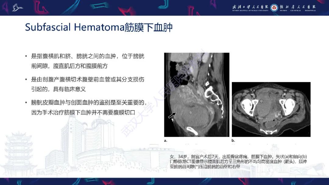 影像PPT - 【PPT】产后并发症影像诊断-30