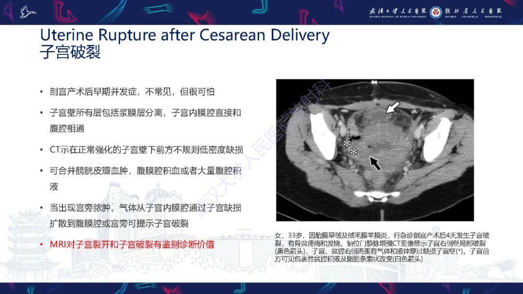影像PPT - 【PPT】产后并发症影像诊断-34