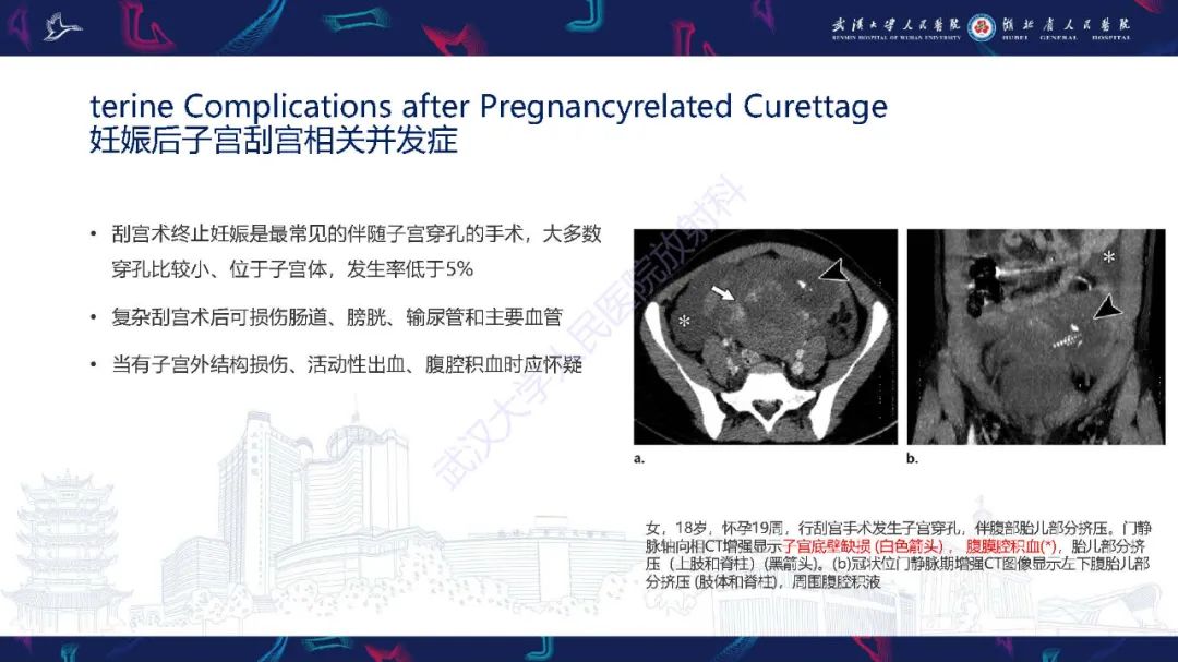 影像PPT - 【PPT】产后并发症影像诊断-37