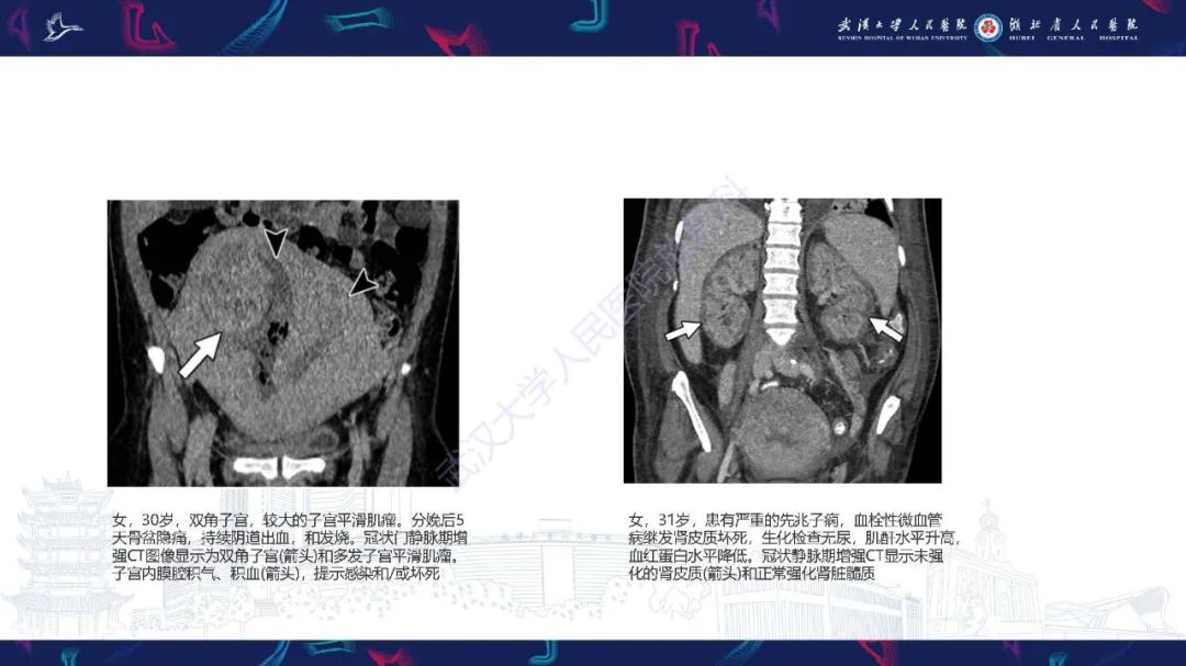 影像PPT - 【PPT】产后并发症影像诊断-39