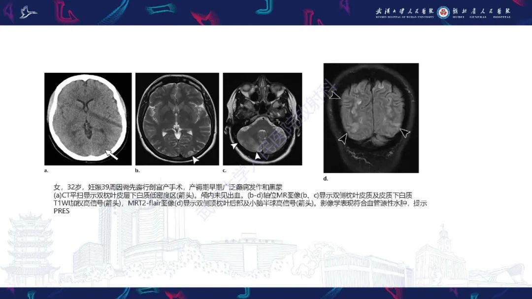 影像PPT - 【PPT】产后并发症影像诊断-41