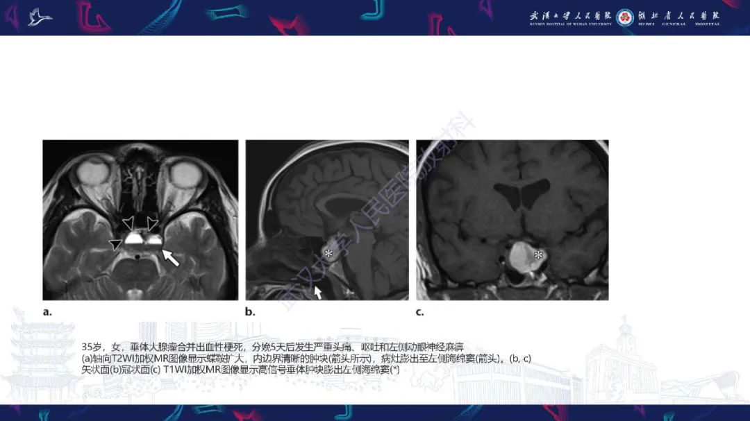 影像PPT - 【PPT】产后并发症影像诊断-42