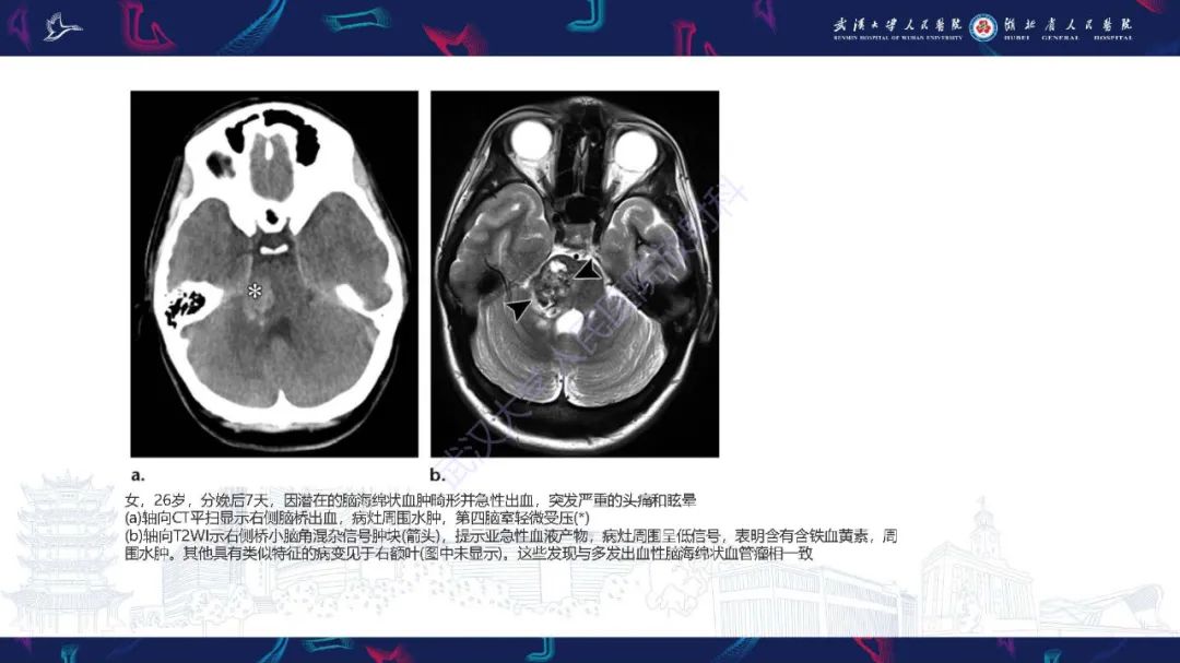 影像PPT - 【PPT】产后并发症影像诊断-43
