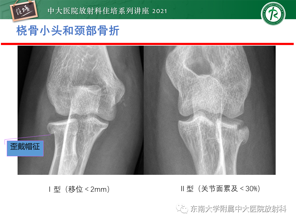 影像PPT - 【PPT】肘关节损伤-4