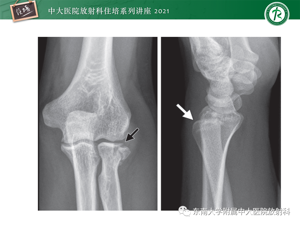 影像PPT - 【PPT】肘关节损伤-5