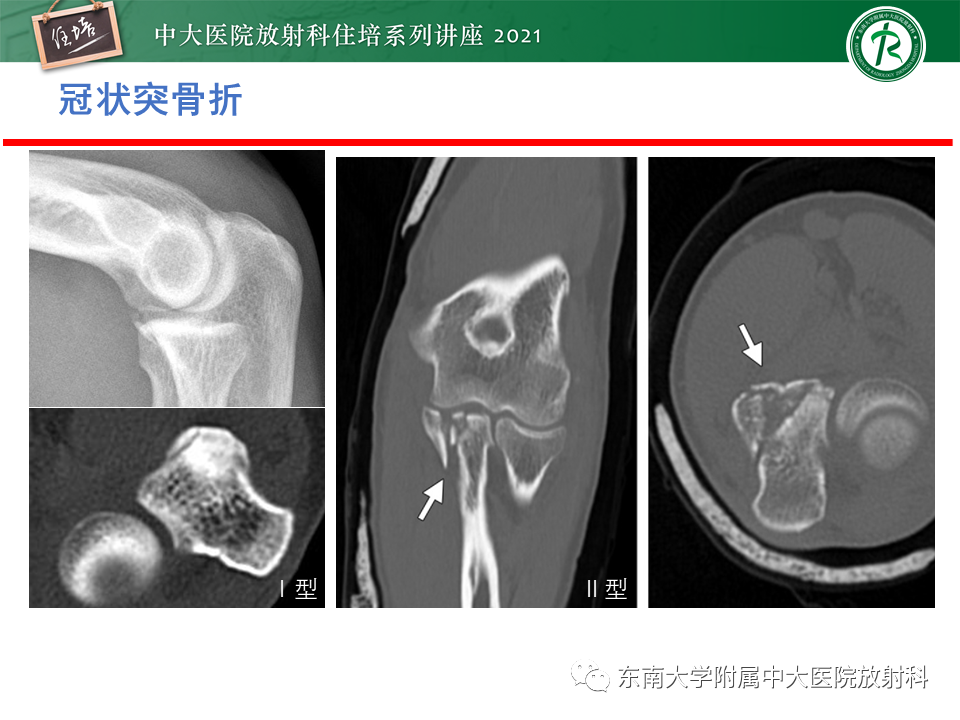 影像PPT - 【PPT】肘关节损伤-10