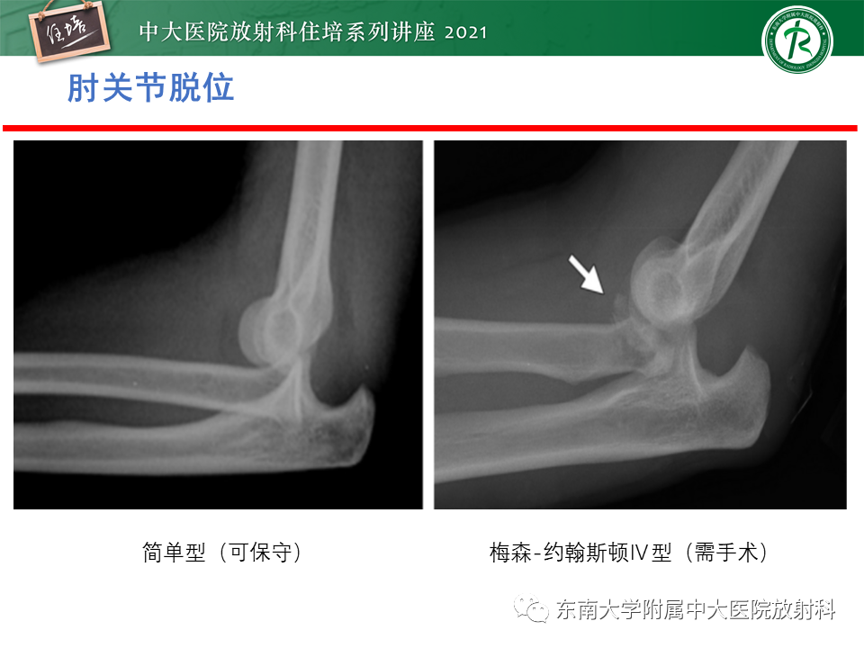 影像PPT - 【PPT】肘关节损伤-14