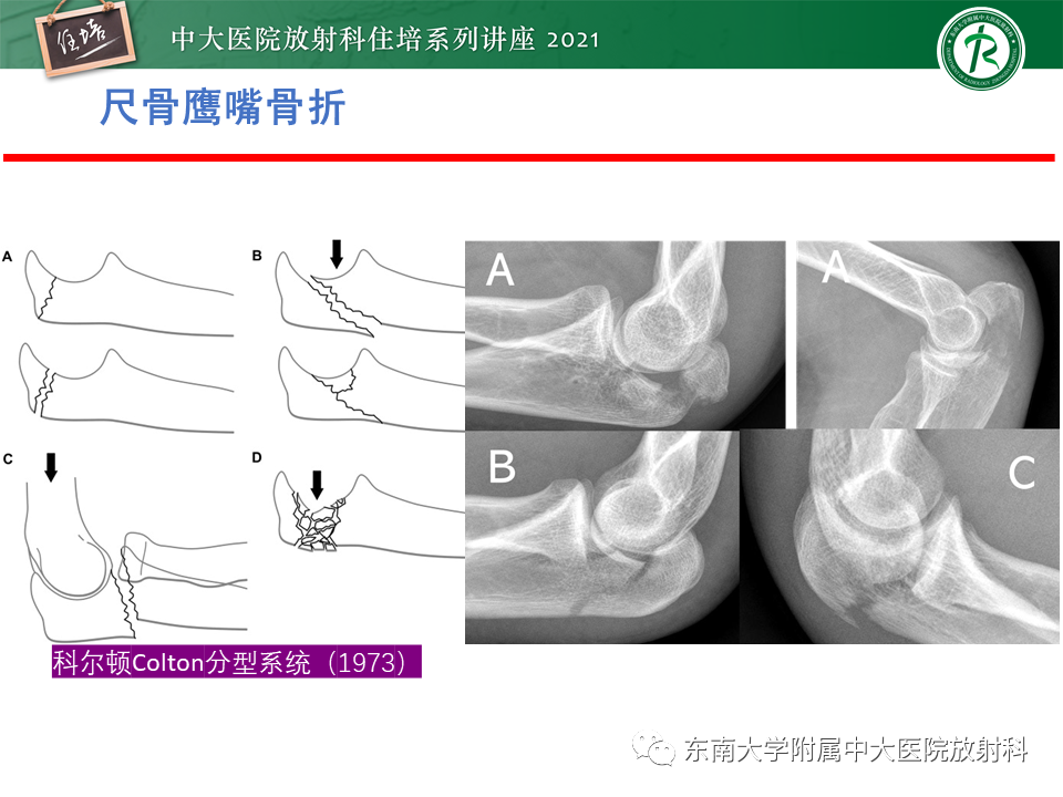影像PPT - 【PPT】肘关节损伤-12