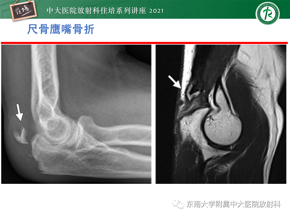 影像PPT - 【PPT】肘关节损伤-13