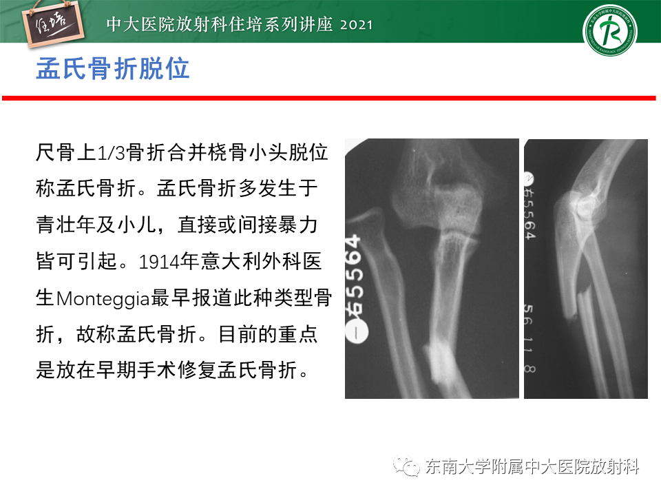影像PPT - 【PPT】肘关节损伤-16
