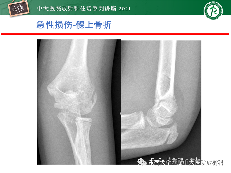 影像PPT - 【PPT】肘关节损伤-20