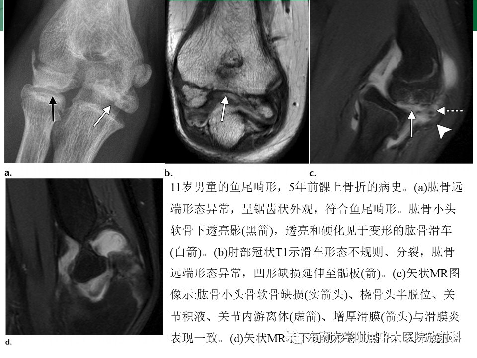 影像PPT - 【PPT】肘关节损伤-22