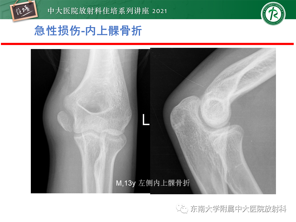 影像PPT - 【PPT】肘关节损伤-26