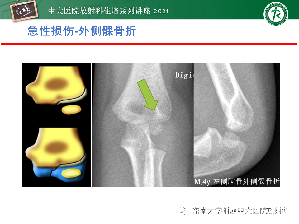 影像PPT - 【PPT】肘关节损伤-24