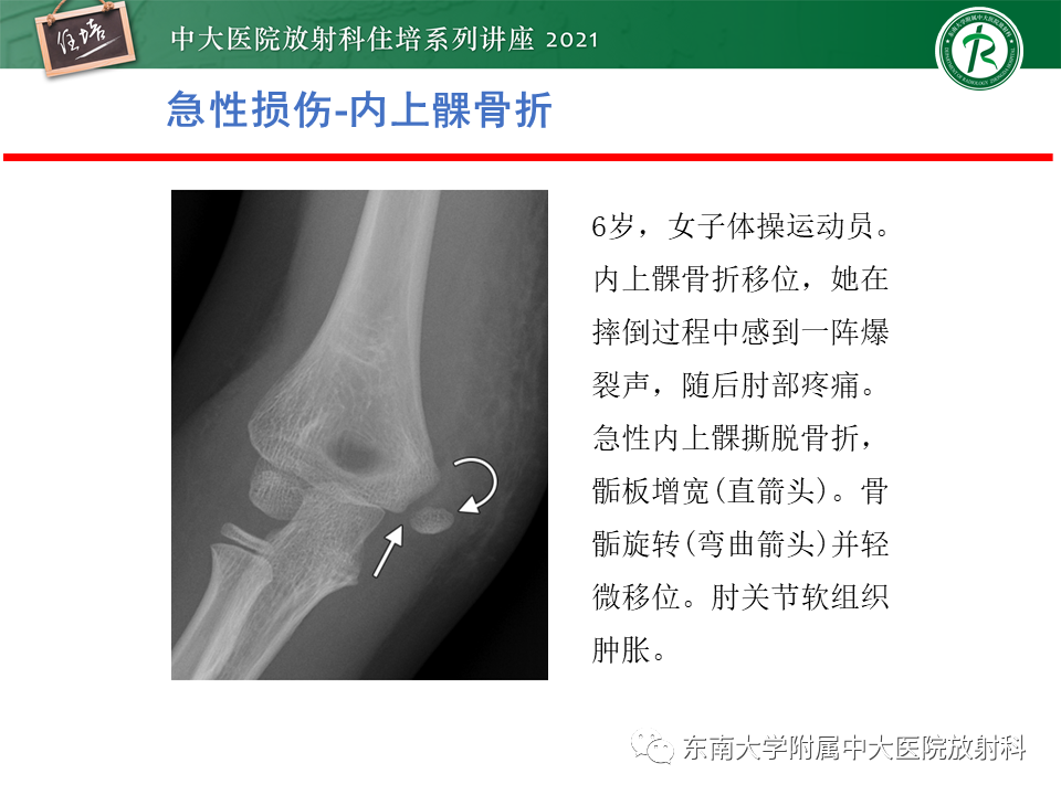 影像PPT - 【PPT】肘关节损伤-27