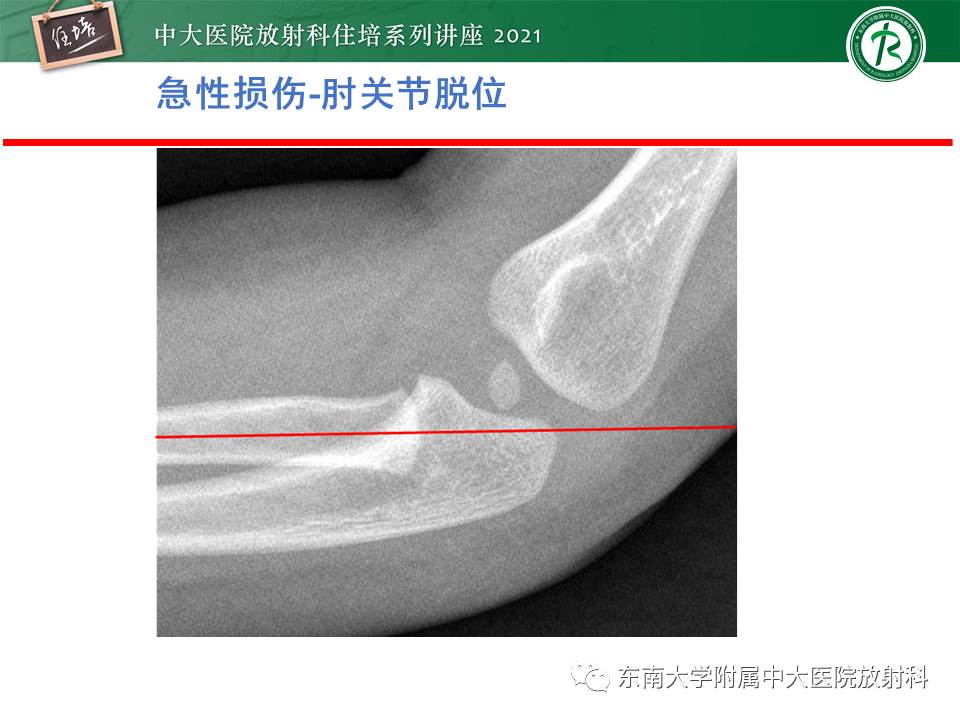 影像PPT - 【PPT】肘关节损伤-32